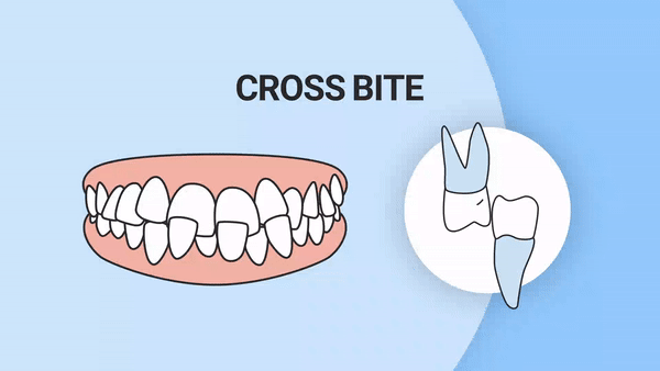 Crossbite teeth gif