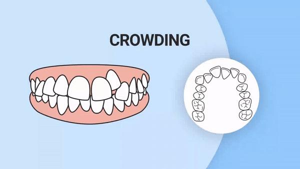 Crowding teeth gif