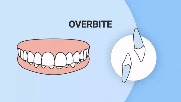 Overbite teeth gif