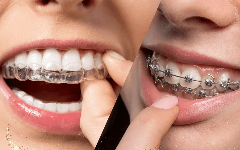 Invisible aligners vs Traditional Metal Braces