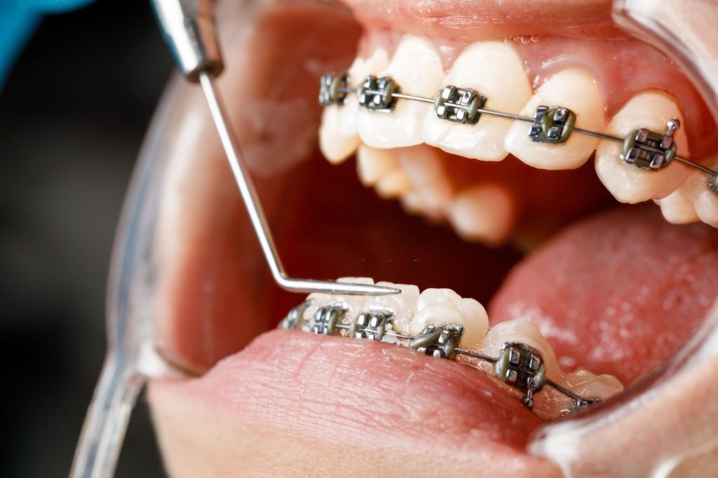 Metal Braces | Retainer: Expectation vs Reality – StarSmiles